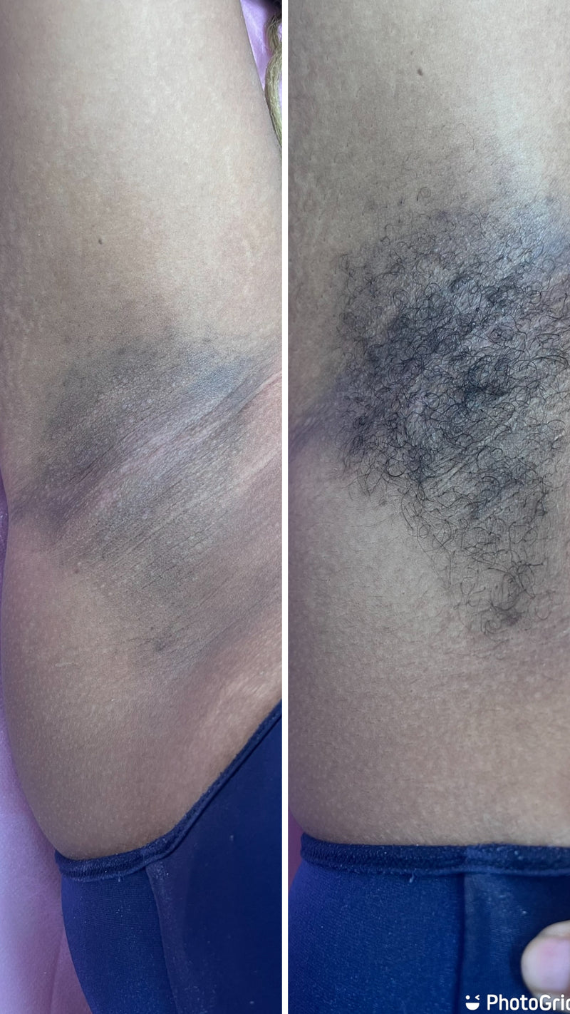 Under Arm Hair Removal